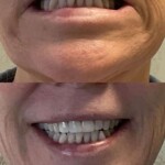Corner of Mouth Botox