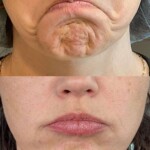 Chin & Corner of Mouth Botox
